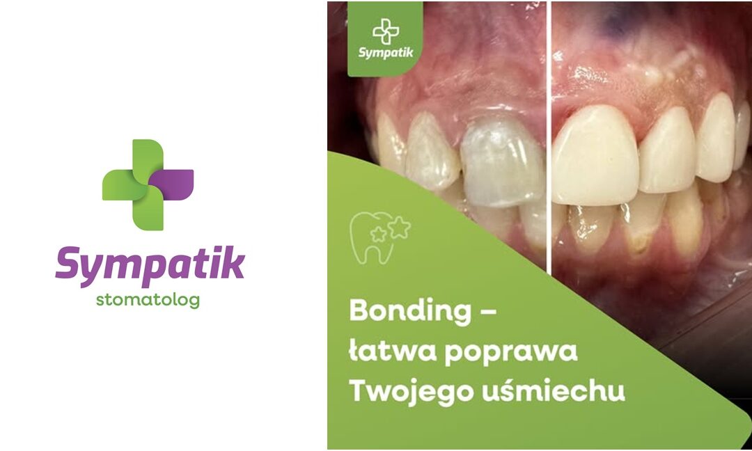 Piękny uśmiech bez długiego leczenia? Tak! Odkryj siłę Bondingu.