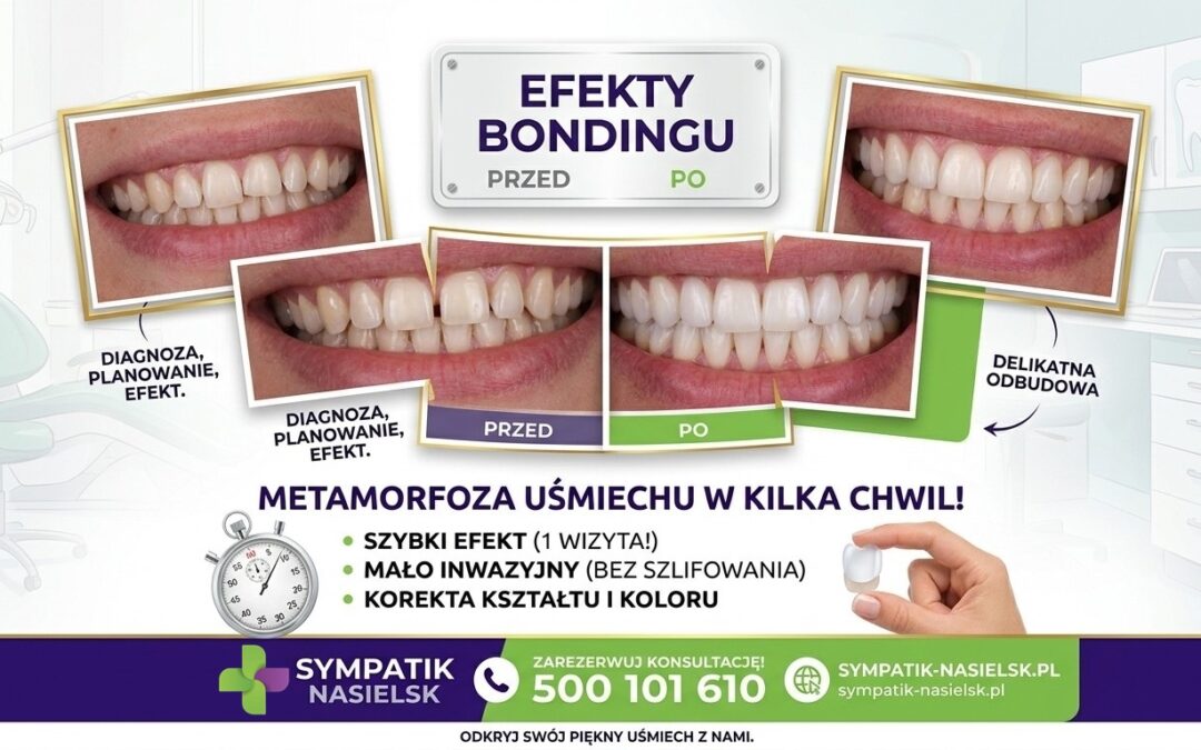 Metamorfoza uśmiechu w jeden dzień – Bonding w Sympatik Nasielsk
