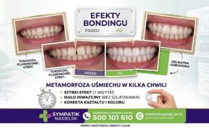 Metamorfoza uśmiechu w jeden dzień – Bonding w Sympatik Nasielsk