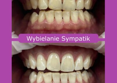 Profesjonalne wybielanie zębów w Nasielsku – odzyskaj blask swojego uśmiechu! (1)