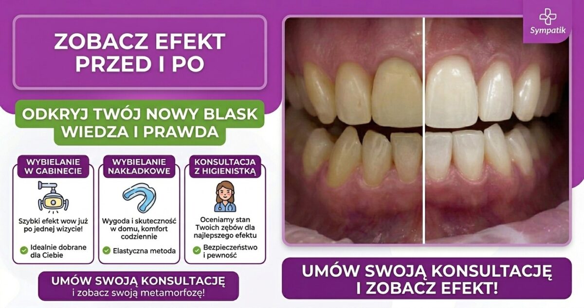 Profesjonalne wybielanie zębów w Nasielsku – odzyskaj blask swojego uśmiechu! (1a)