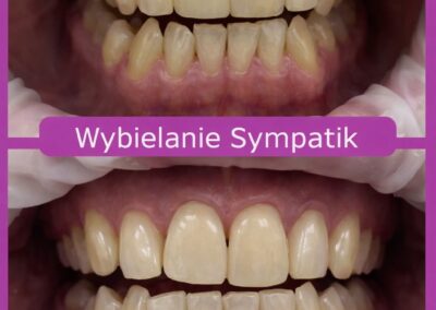 Profesjonalne wybielanie zębów w Nasielsku – odzyskaj blask swojego uśmiechu! (3)
