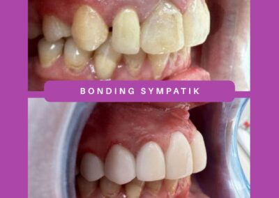 zabieg bondingu Sympatik Nasielsk (1)