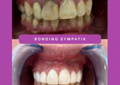 zabieg bondingu Sympatik Nasielsk (2)