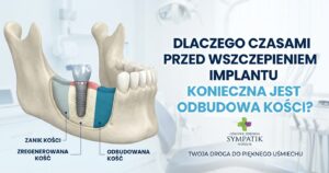 Dlaczego odbudowa kości pod implanty jest konieczna? | Sympatik