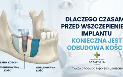 Dlaczego odbudowa kości pod implanty jest konieczna? | Sympatik